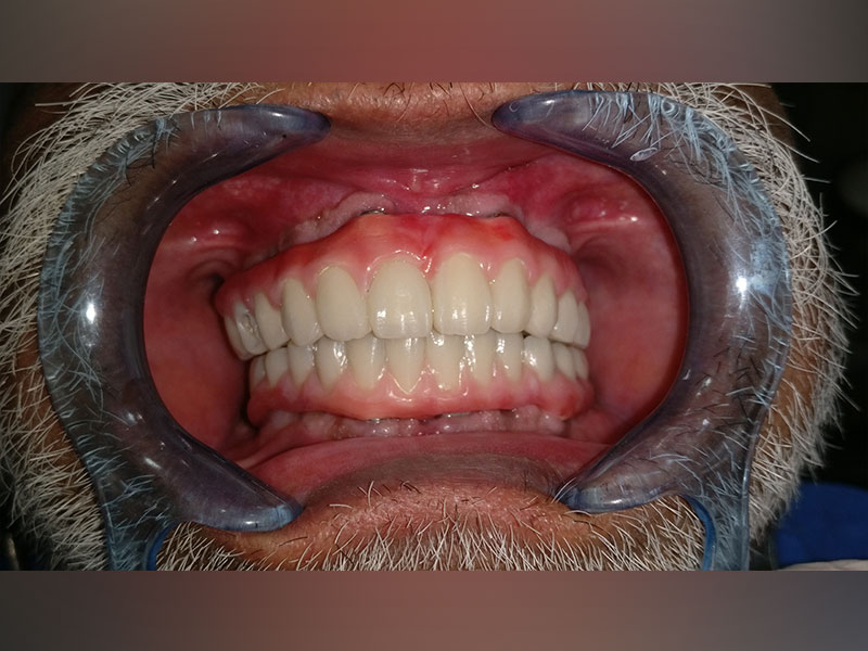 Case 1 - Full Mouth Immediate Rehabiltation