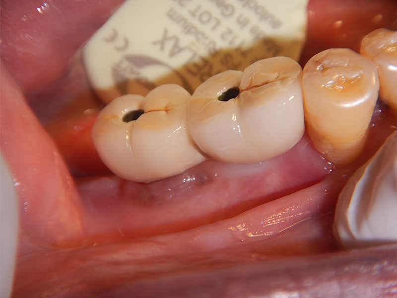 Case 2 - multiple dental implant