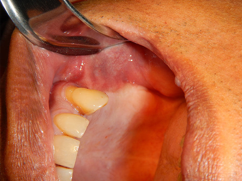 Case 2 - multiple dental implant