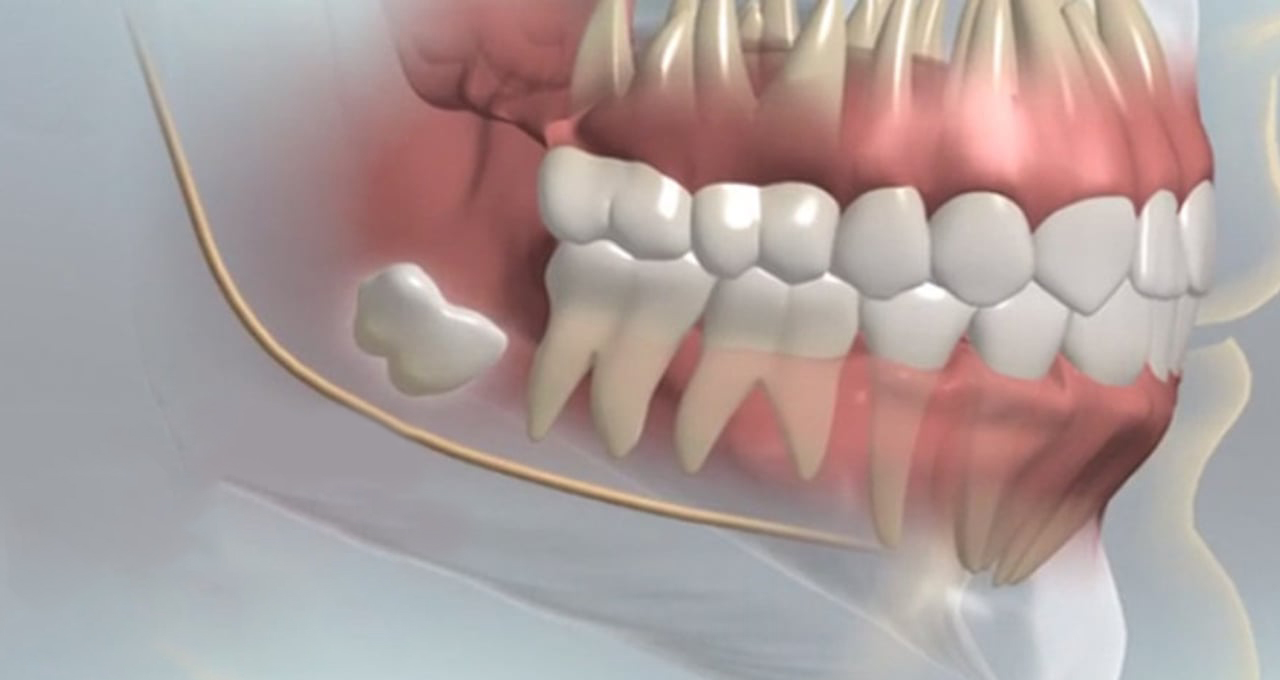 Third Molar Extraction